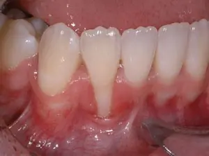 Periodontoloji - Bahçelievler Diş Hekimi