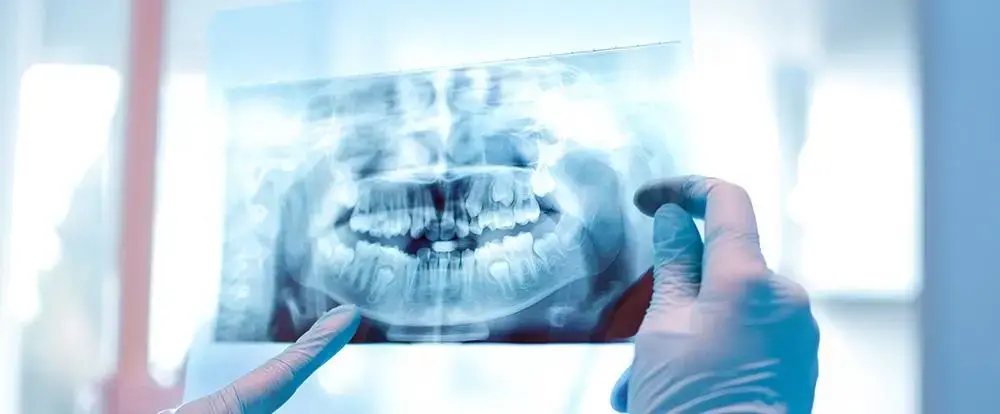 Digital dental imaging results showing detailed tooth and jaw structure